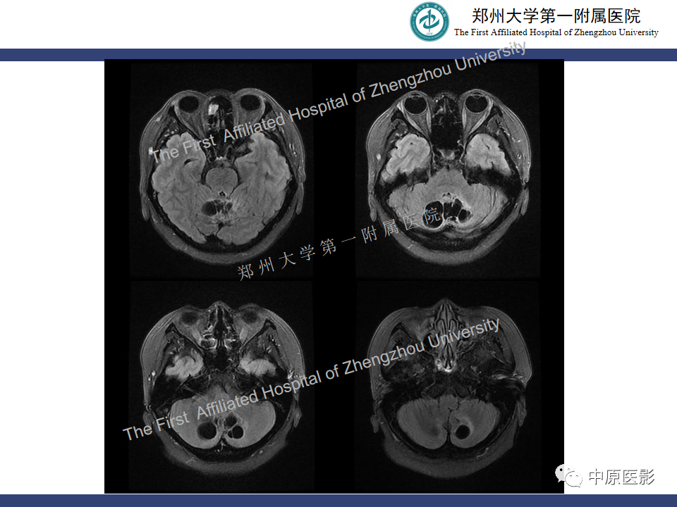影像PPT - 【病例】小脑节细胞胶质瘤1例MR影像-5