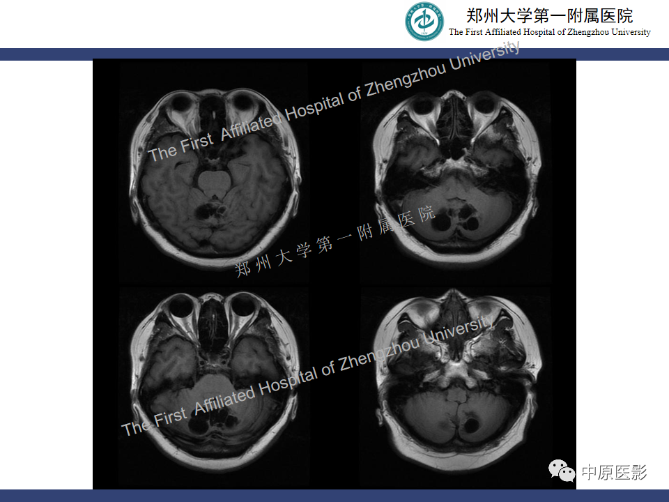 影像PPT - 【病例】小脑节细胞胶质瘤1例MR影像-3