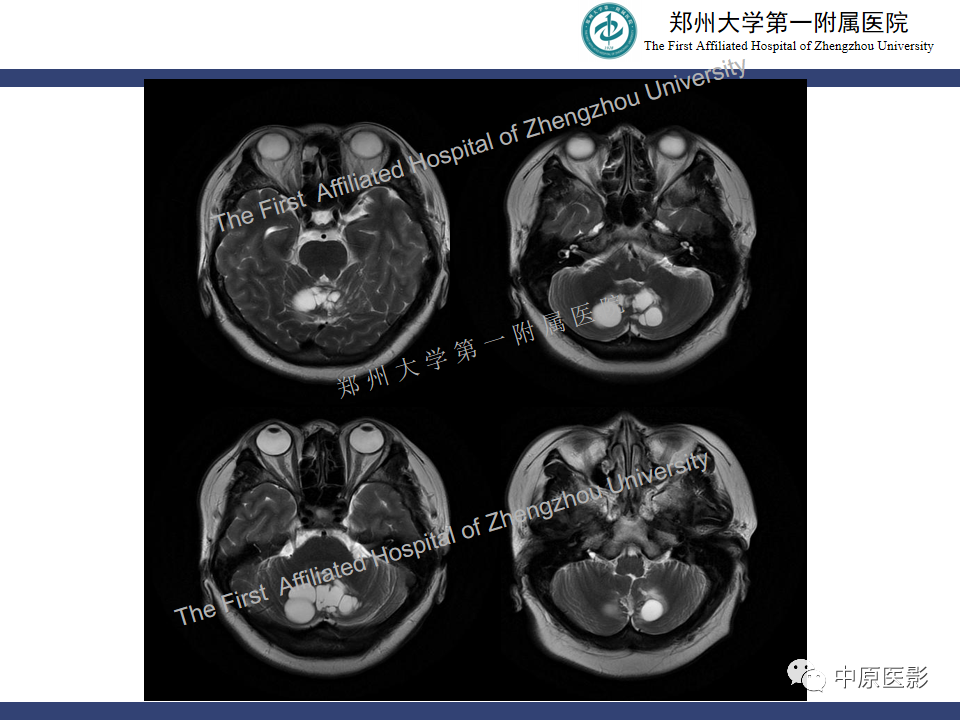 影像PPT - 【病例】小脑节细胞胶质瘤1例MR影像-4