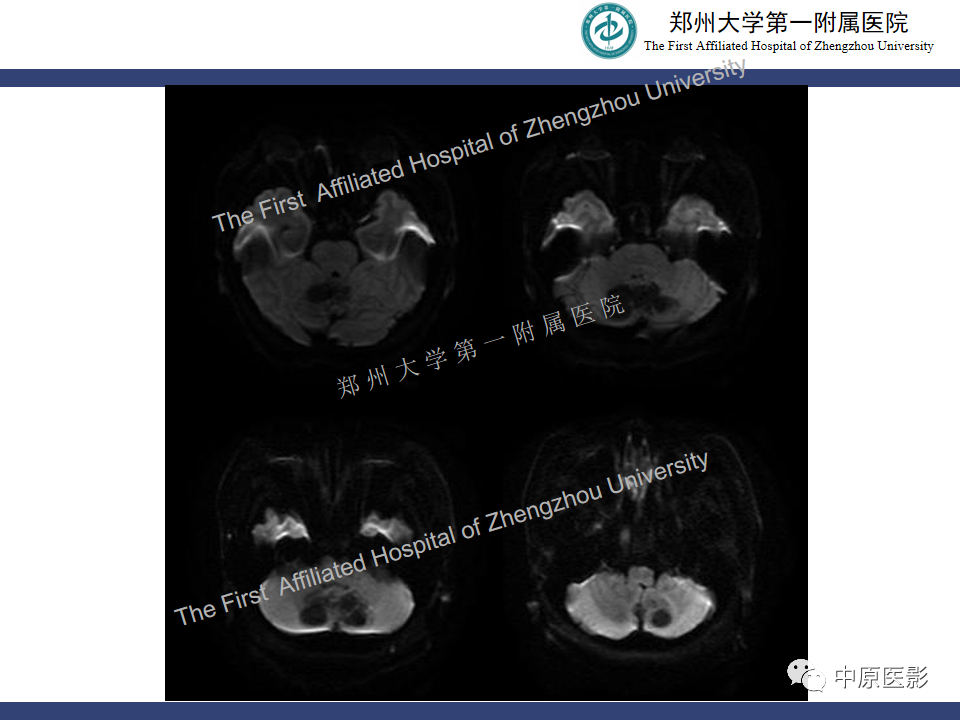 影像PPT - 【病例】小脑节细胞胶质瘤1例MR影像-6