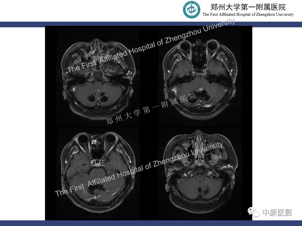 影像PPT - 【病例】小脑节细胞胶质瘤1例MR影像-7