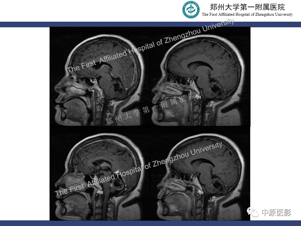 影像PPT - 【病例】小脑节细胞胶质瘤1例MR影像-8