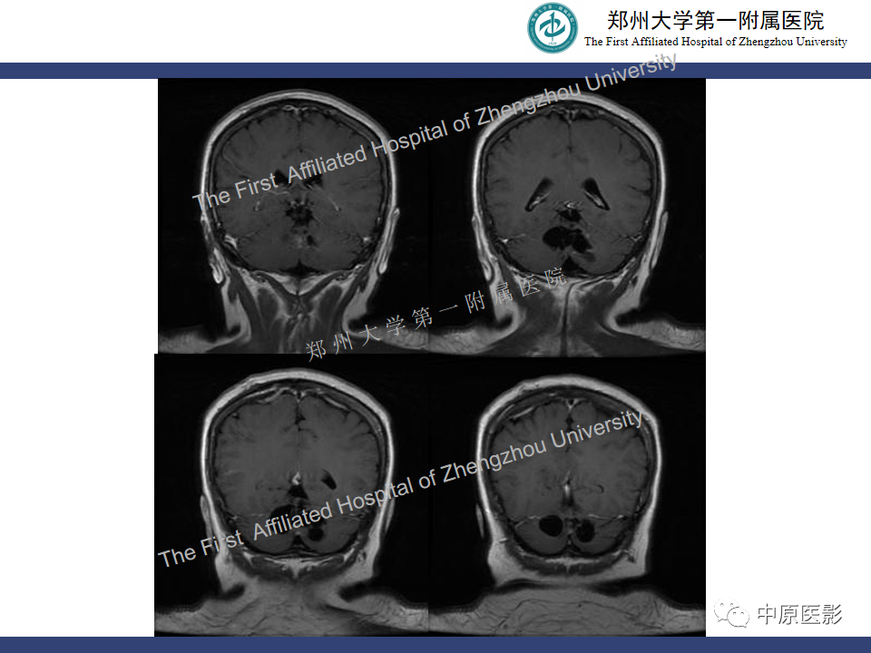影像PPT - 【病例】小脑节细胞胶质瘤1例MR影像-9