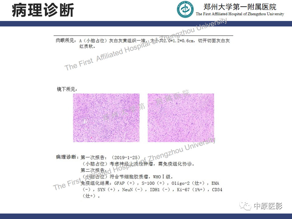 影像PPT - 【病例】小脑节细胞胶质瘤1例MR影像-12
