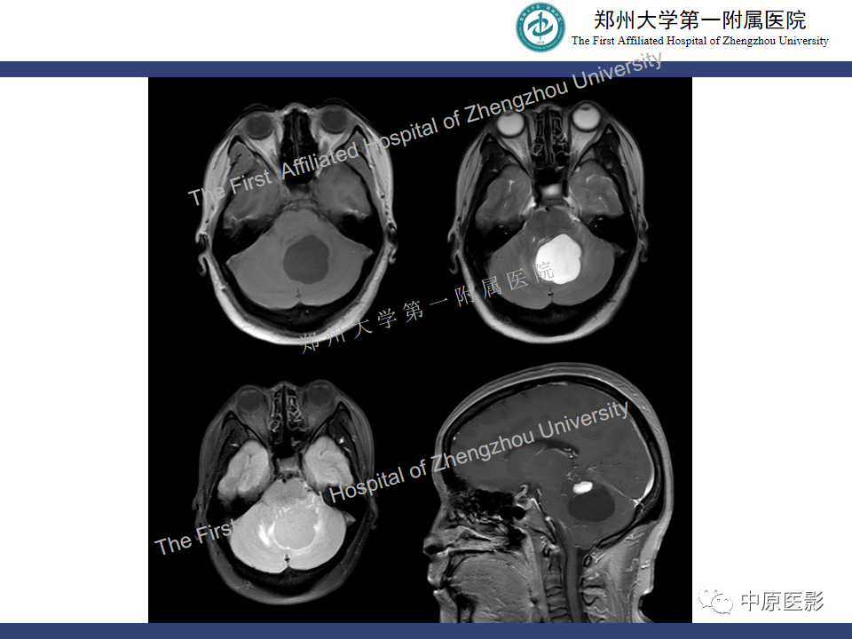 影像PPT - 【病例】小脑节细胞胶质瘤1例MR影像-18