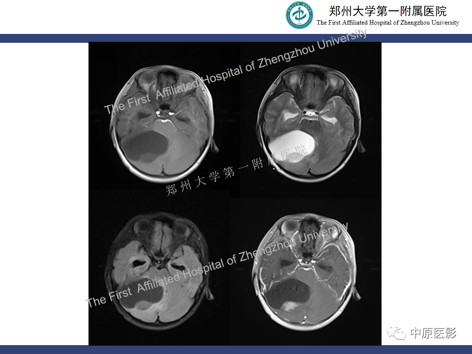 影像PPT - 【病例】小脑节细胞胶质瘤1例MR影像-20