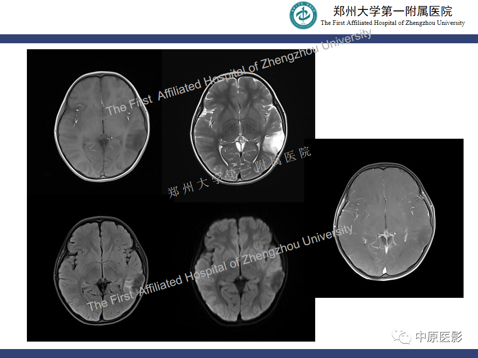 影像PPT - 【病例】小脑节细胞胶质瘤1例MR影像-22