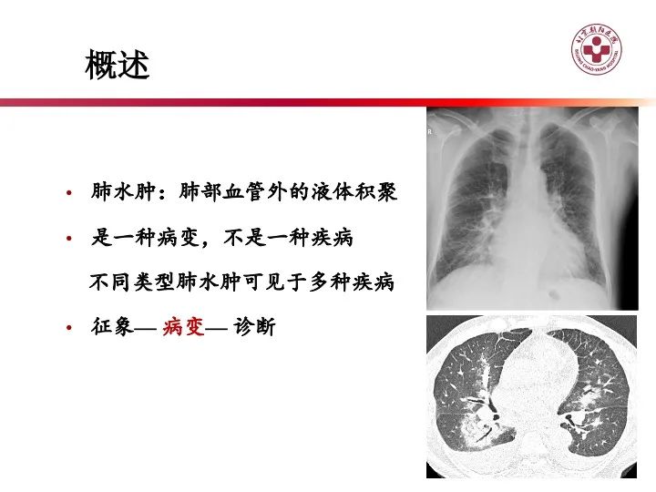影像PPT - 【PPT】肺水肿的临床与影像-2