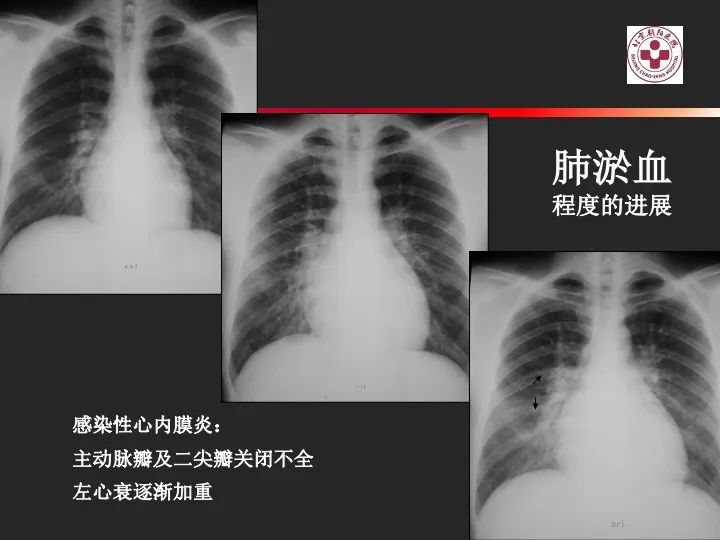 影像PPT - 【PPT】肺水肿的临床与影像-7
