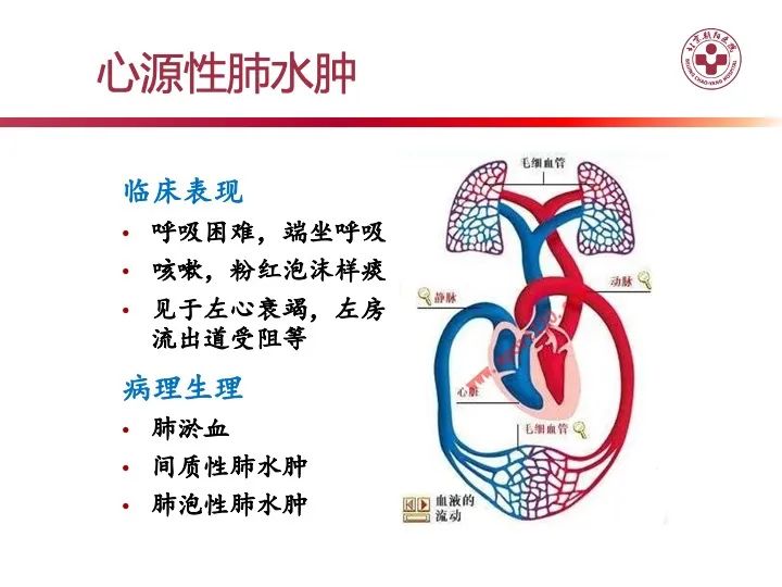 影像PPT - 【PPT】肺水肿的临床与影像-6