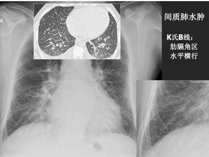 影像PPT - 【PPT】肺水肿的临床与影像-8