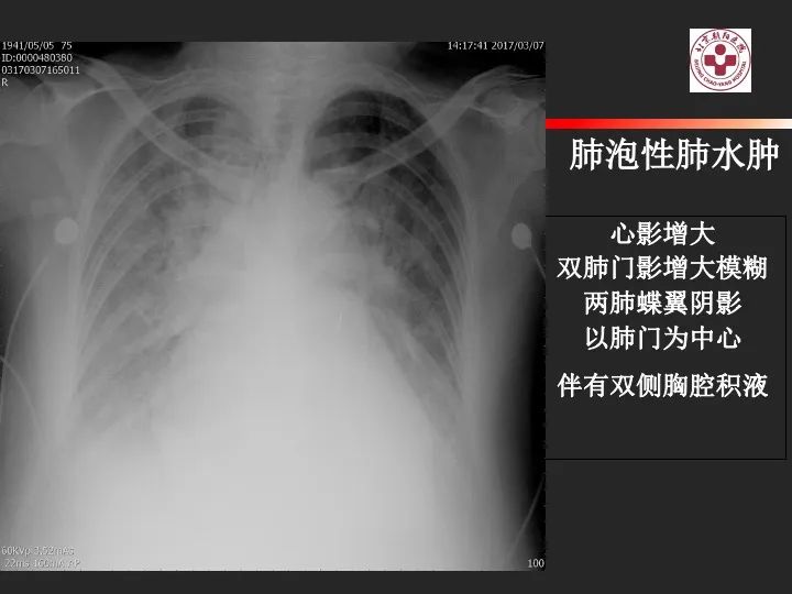 影像PPT - 【PPT】肺水肿的临床与影像-9
