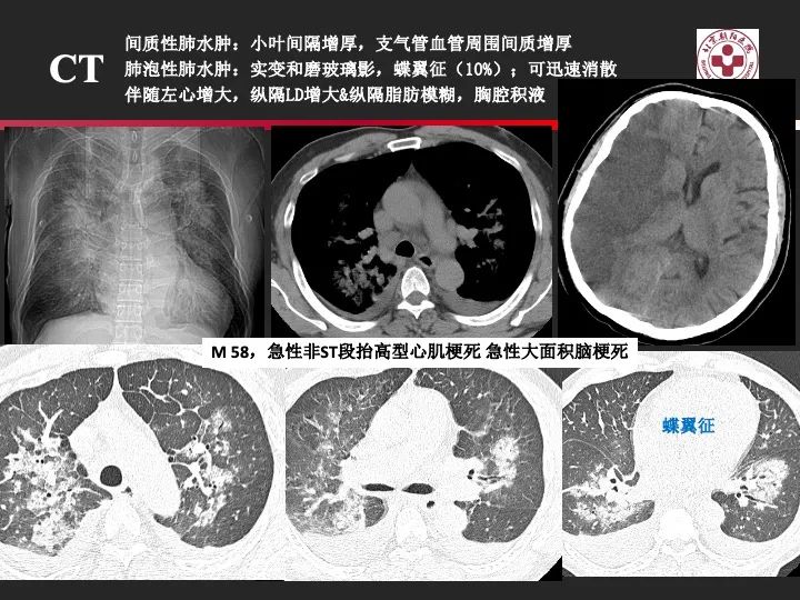 影像PPT - 【PPT】肺水肿的临床与影像-10