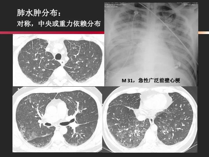 影像PPT - 【PPT】肺水肿的临床与影像-11
