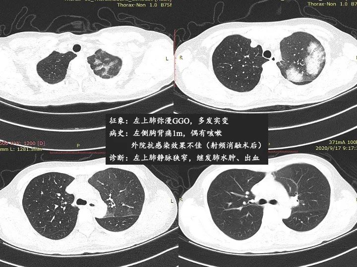 影像PPT - 【PPT】肺水肿的临床与影像-13