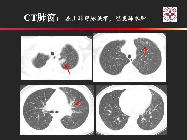影像PPT - 【PPT】肺水肿的临床与影像-16
