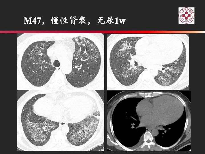 影像PPT - 【PPT】肺水肿的临床与影像-18