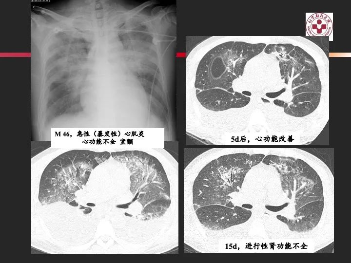 影像PPT - 【PPT】肺水肿的临床与影像-19