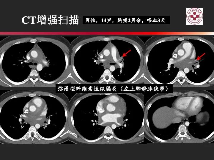 影像PPT - 【PPT】肺水肿的临床与影像-15