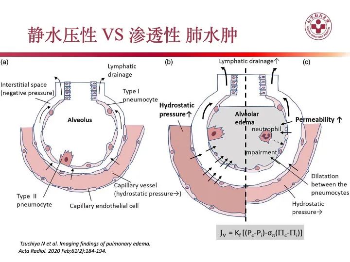 影像PPT - 【PPT】肺水肿的临床与影像-20
