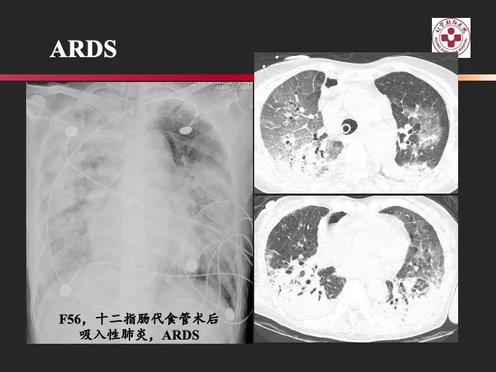 影像PPT - 【PPT】肺水肿的临床与影像-23