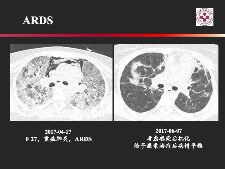 影像PPT - 【PPT】肺水肿的临床与影像-24