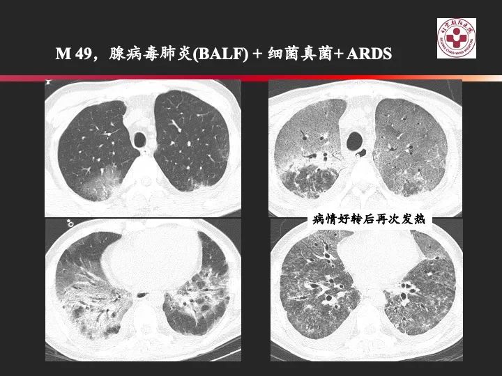 影像PPT - 【PPT】肺水肿的临床与影像-25