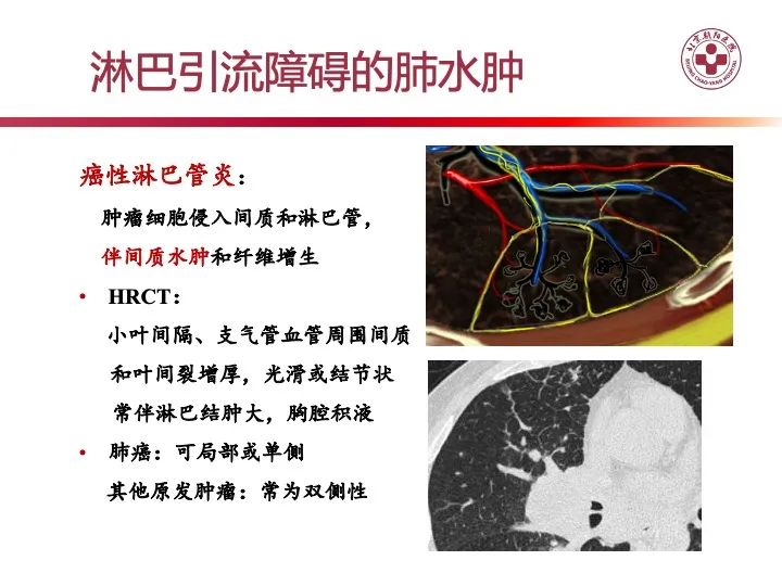 影像PPT - 【PPT】肺水肿的临床与影像-27