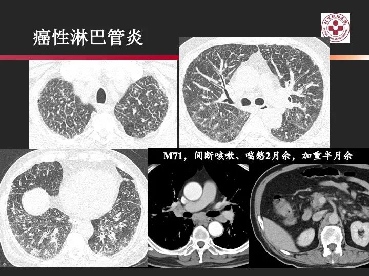 影像PPT - 【PPT】肺水肿的临床与影像-28