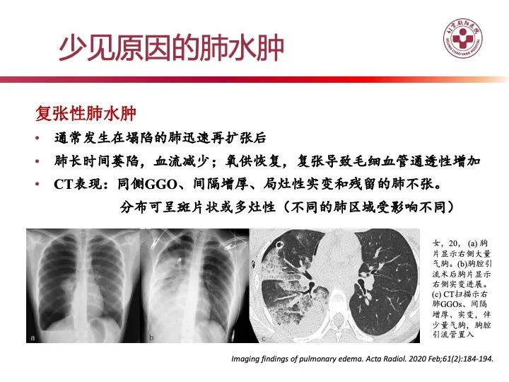 影像PPT - 【PPT】肺水肿的临床与影像-29
