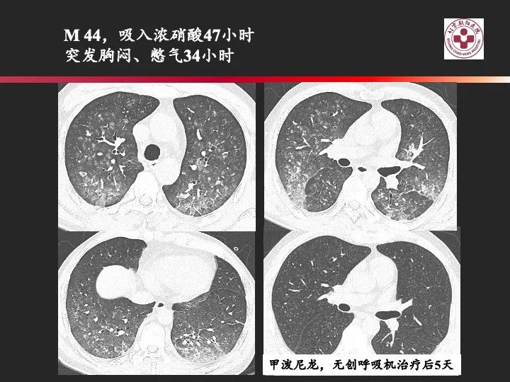 影像PPT - 【PPT】肺水肿的临床与影像-31