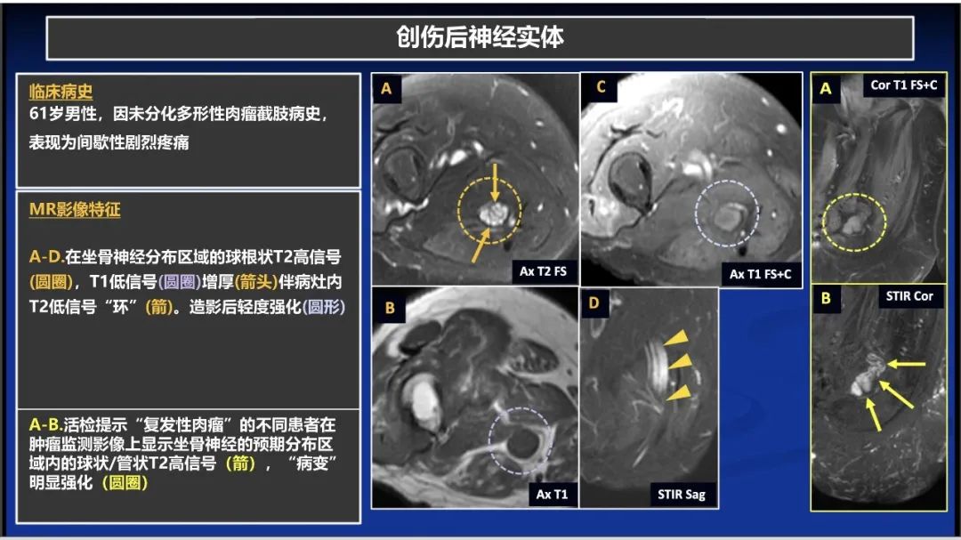 影像PPT - 【PPT】除了神经鞘瘤和神经纤维瘤：与神经相关的良性和恶性病变综述-1
