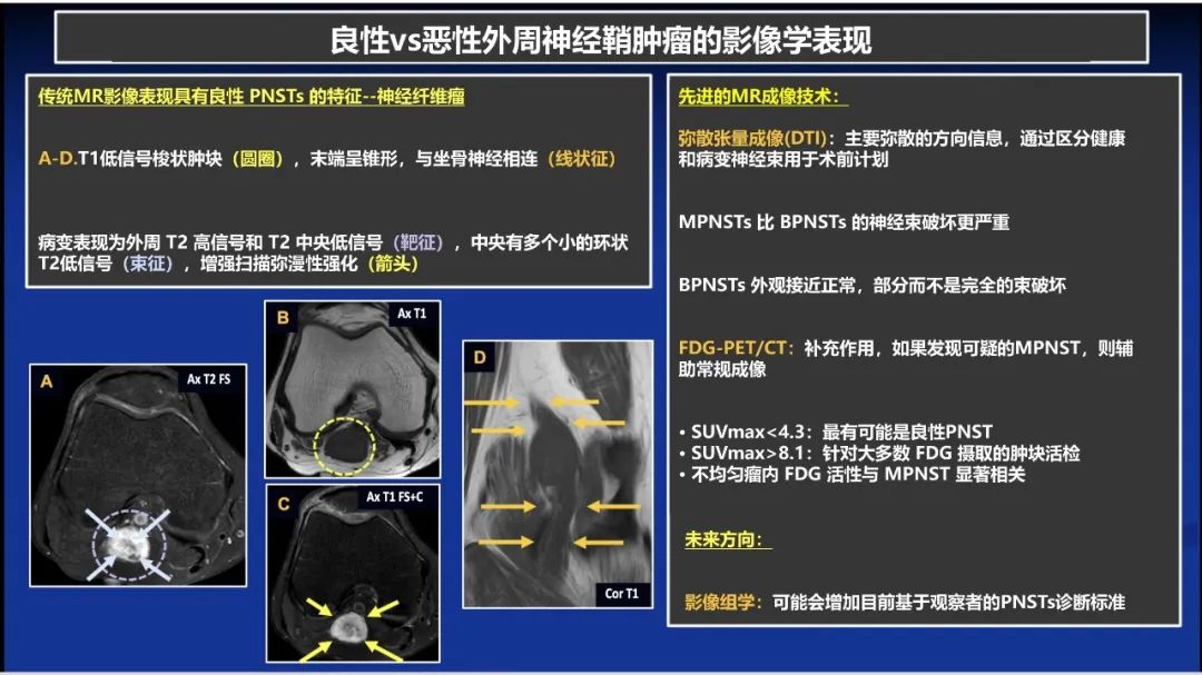 影像PPT - 【PPT】除了神经鞘瘤和神经纤维瘤：与神经相关的良性和恶性病变综述-5