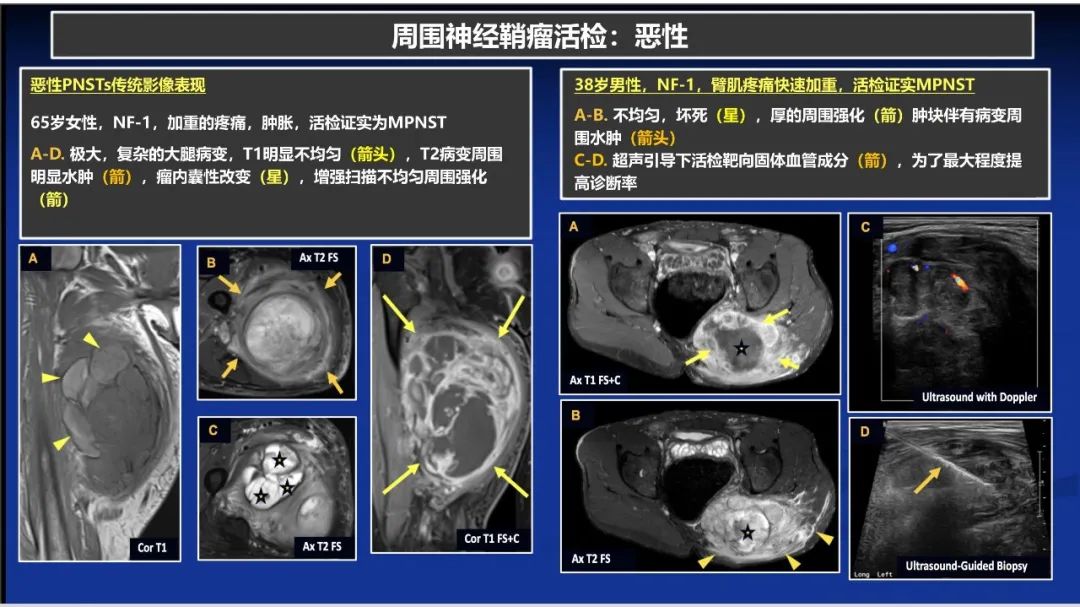 影像PPT - 【PPT】除了神经鞘瘤和神经纤维瘤：与神经相关的良性和恶性病变综述-9