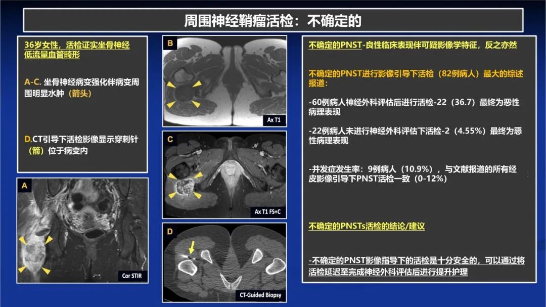 影像PPT - 【PPT】除了神经鞘瘤和神经纤维瘤：与神经相关的良性和恶性病变综述-13
