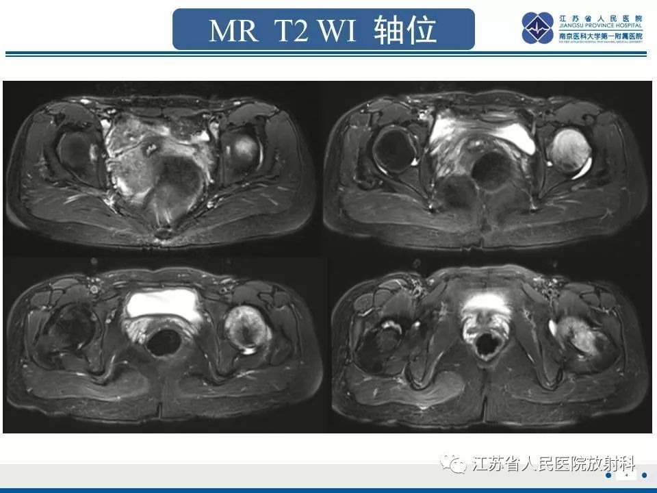 影像PPT - 【PPT】髋关节一过性骨质疏松-5