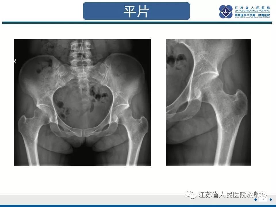 影像PPT - 【PPT】髋关节一过性骨质疏松-3