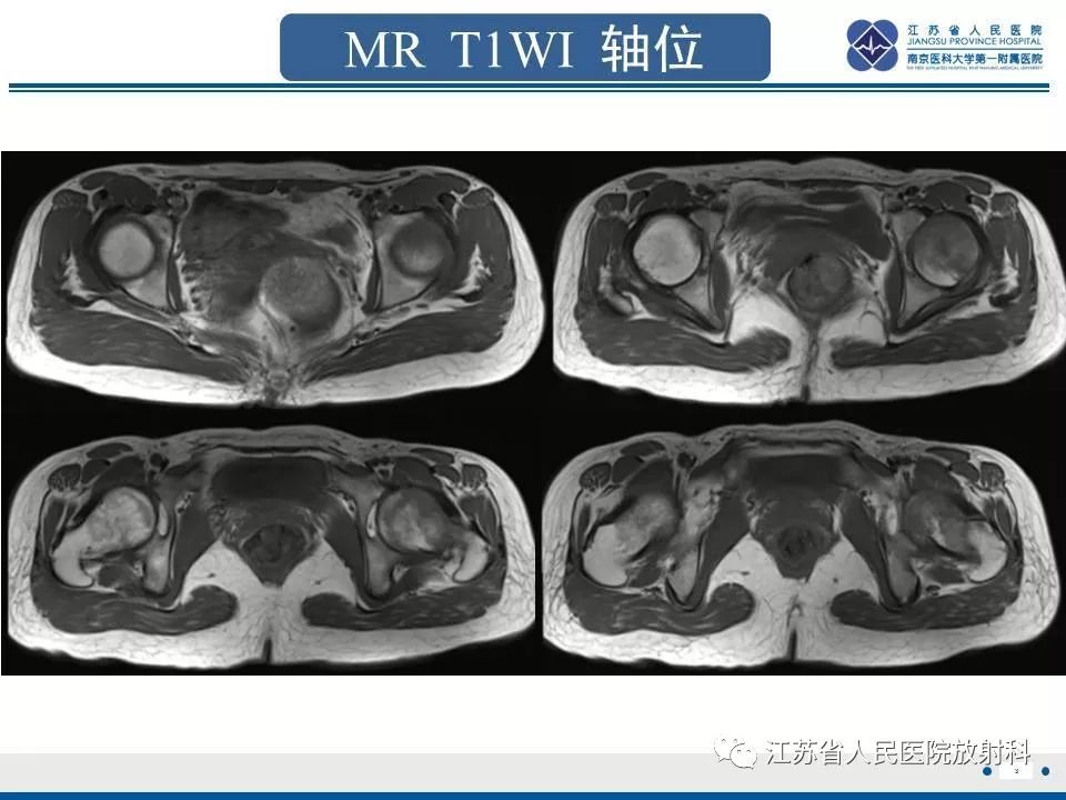 影像PPT - 【PPT】髋关节一过性骨质疏松-4
