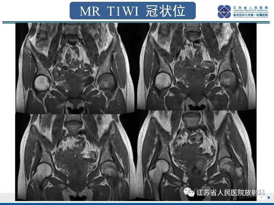 影像PPT - 【PPT】髋关节一过性骨质疏松-6