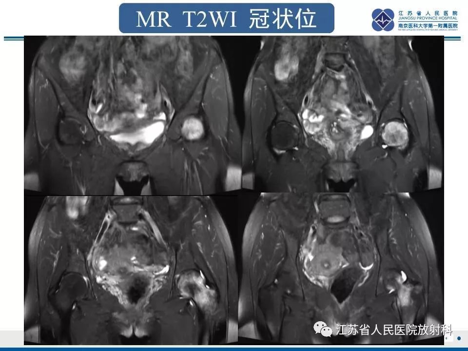 影像PPT - 【PPT】髋关节一过性骨质疏松-7