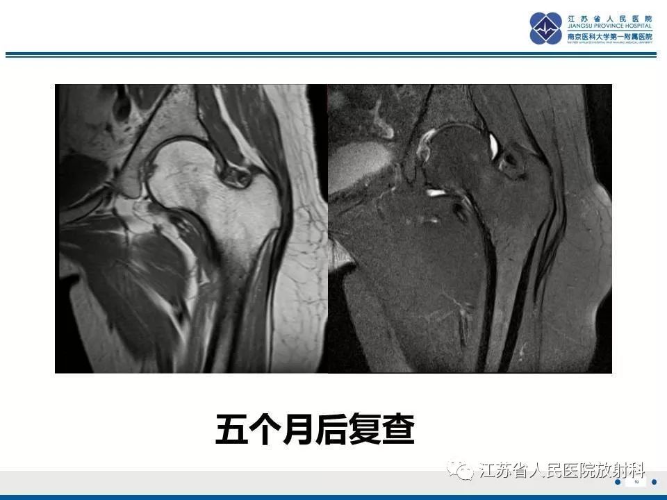 影像PPT - 【PPT】髋关节一过性骨质疏松-11