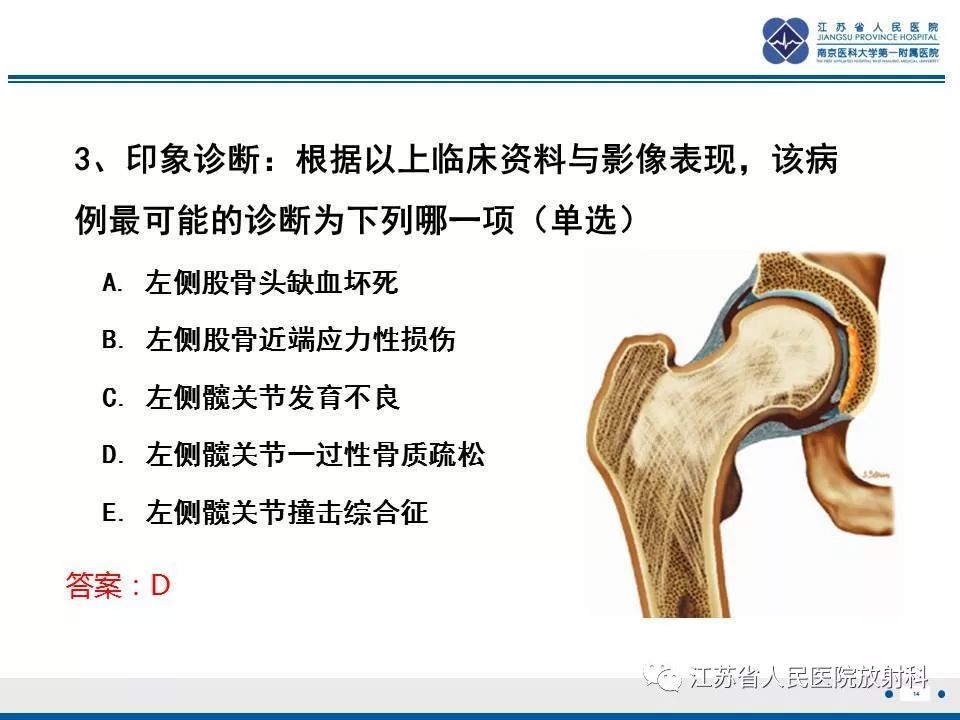 影像PPT - 【PPT】髋关节一过性骨质疏松-15