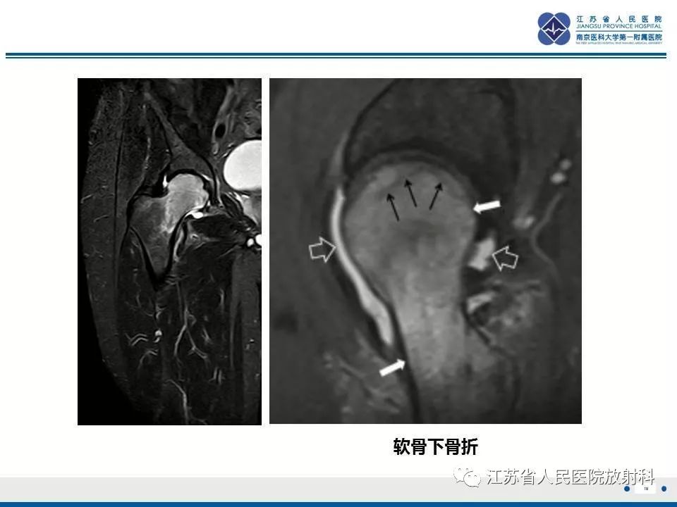 影像PPT - 【PPT】髋关节一过性骨质疏松-19