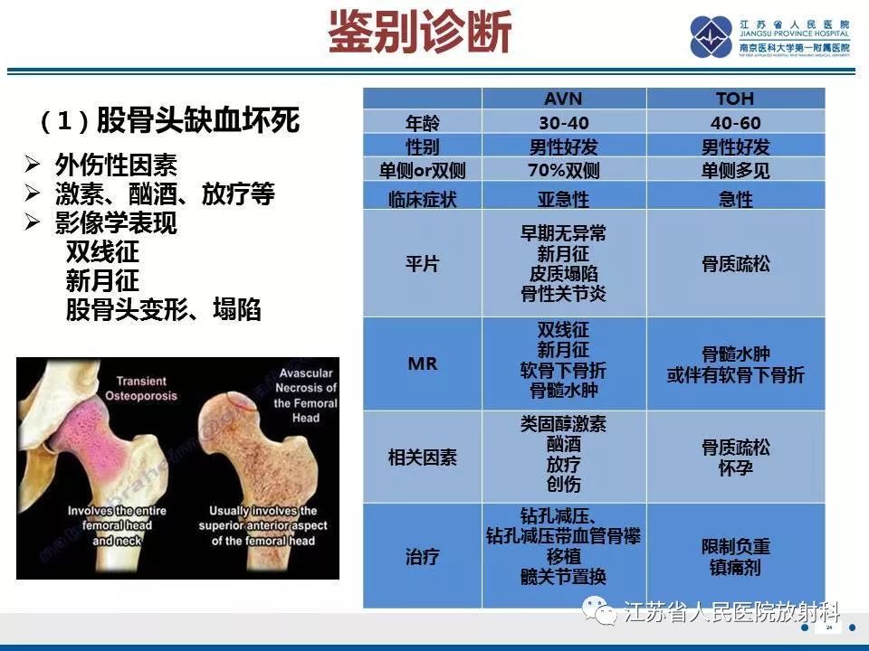 影像PPT - 【PPT】髋关节一过性骨质疏松-25