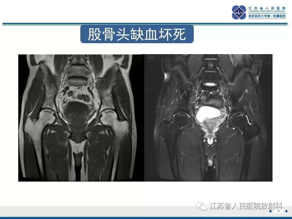 影像PPT - 【PPT】髋关节一过性骨质疏松-26