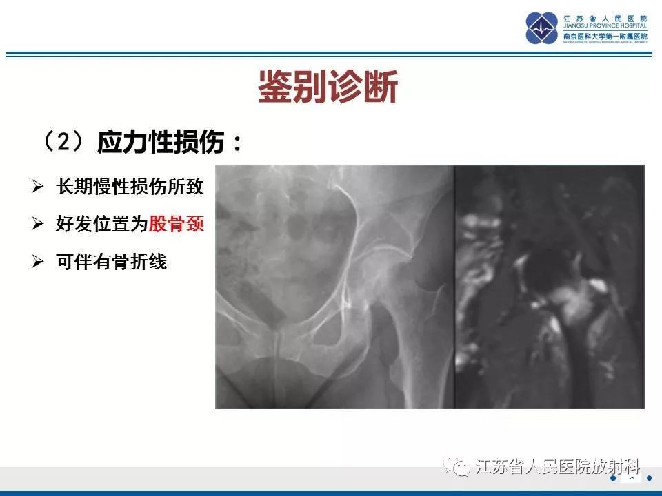 影像PPT - 【PPT】髋关节一过性骨质疏松-27