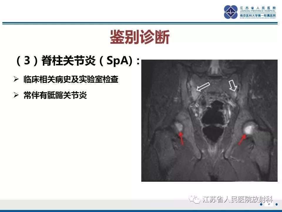 影像PPT - 【PPT】髋关节一过性骨质疏松-28
