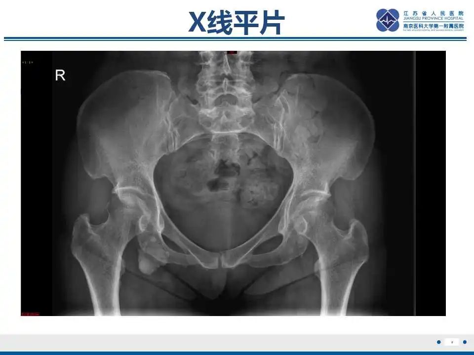 影像PPT - 【PPT】肿瘤样钙质沉着症-3