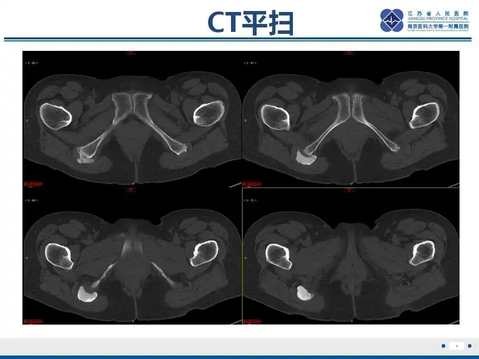 影像PPT - 【PPT】肿瘤样钙质沉着症-4