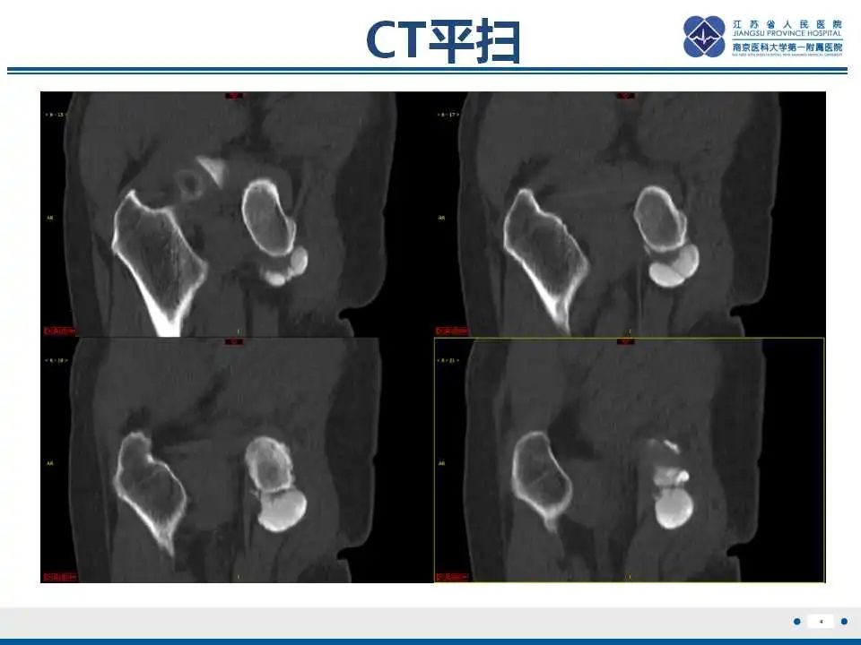 影像PPT - 【PPT】肿瘤样钙质沉着症-5